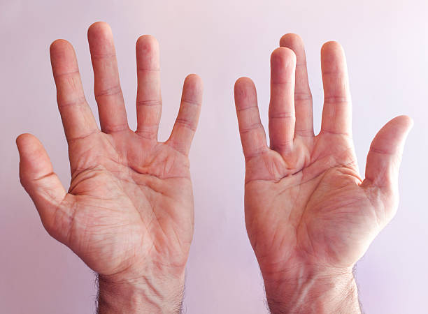 Know more about best Dupuytren's contracture surgery and symptoms in Aberdeen