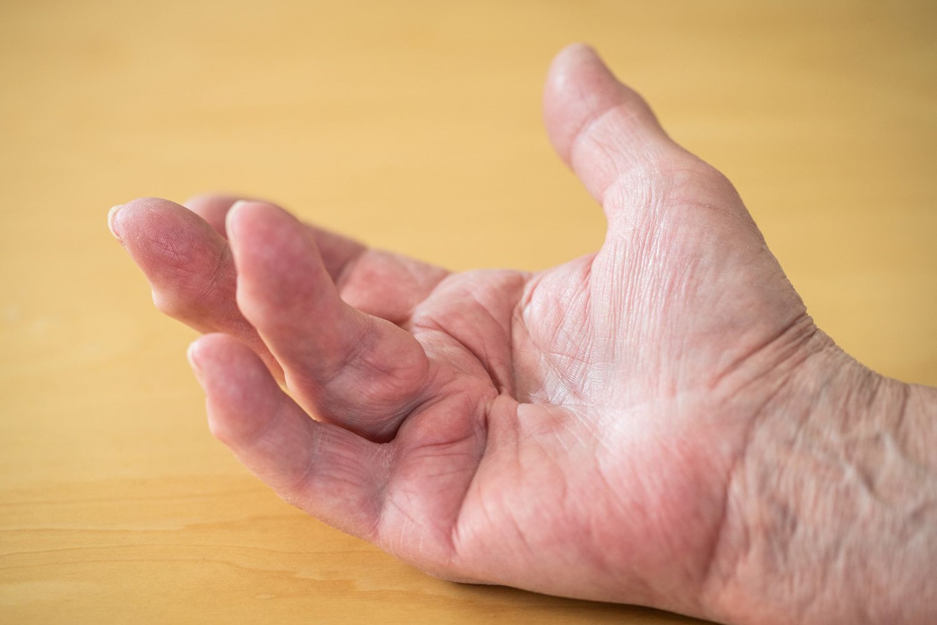 Dos of Dupuytren's contracture in Aberdeen, uk by Dr Jamil Ahmed 
