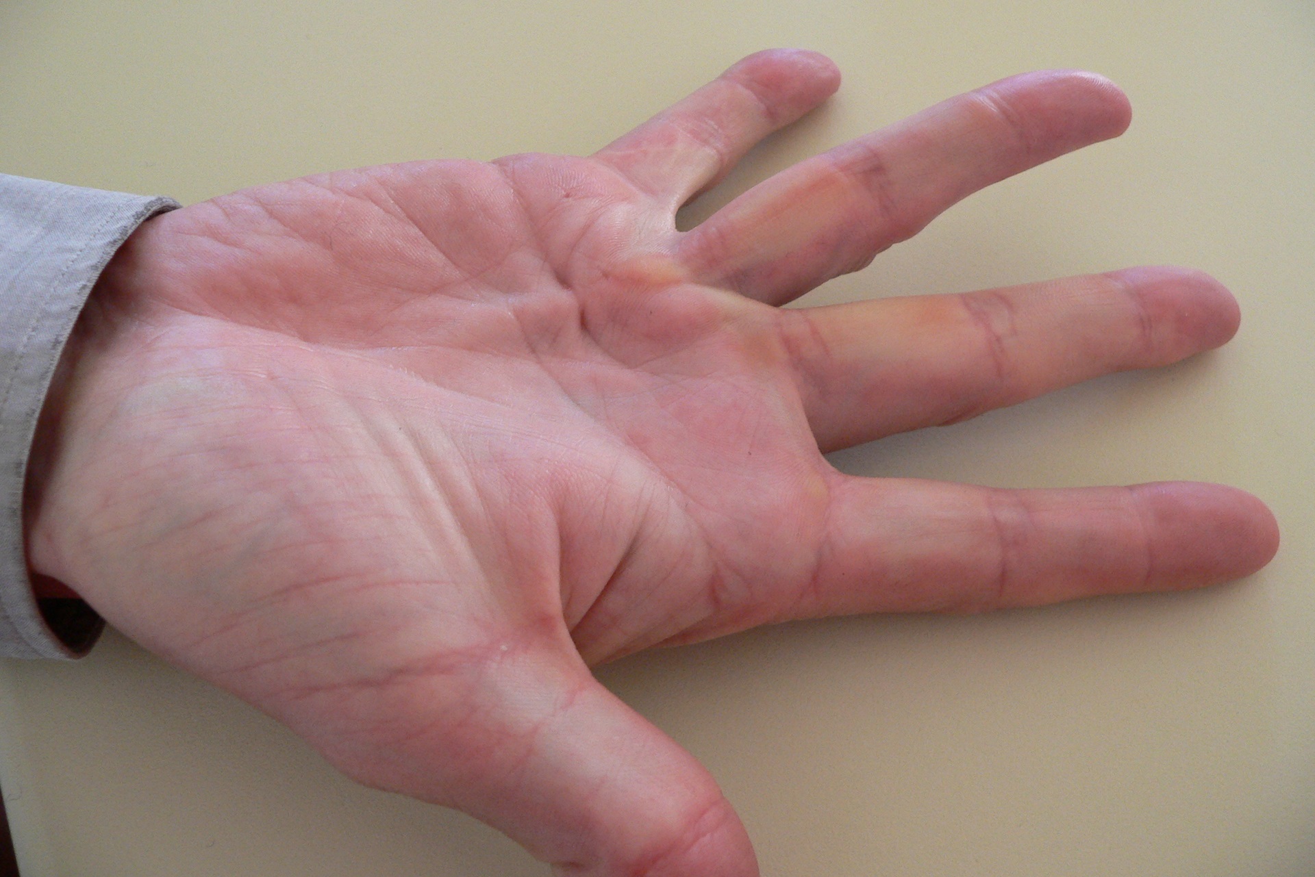  Donts of Dupuytren's contracture in Aberdeen, uk by Dr Jamil Ahmed