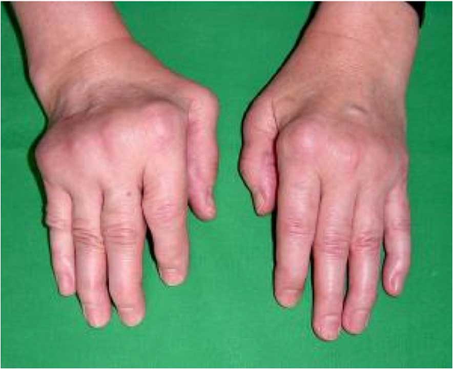 Best and affordable Rheumatoid hand surgery in Aberdeen, uk by Dr Jamil Ahmed