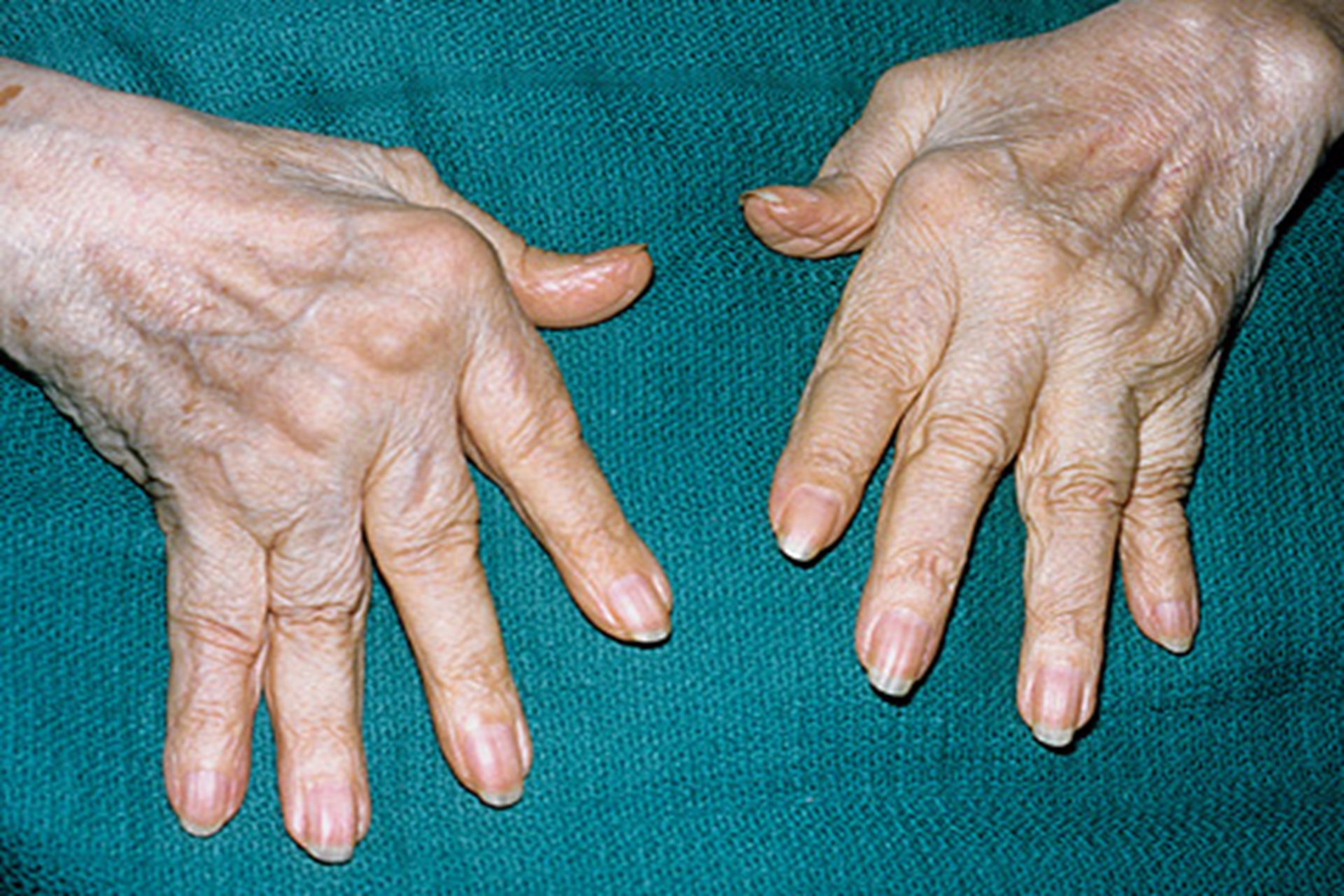 Benefits of Rheumatoid hand surgery in aberdeen, Uk by DR Jamil Ahmed