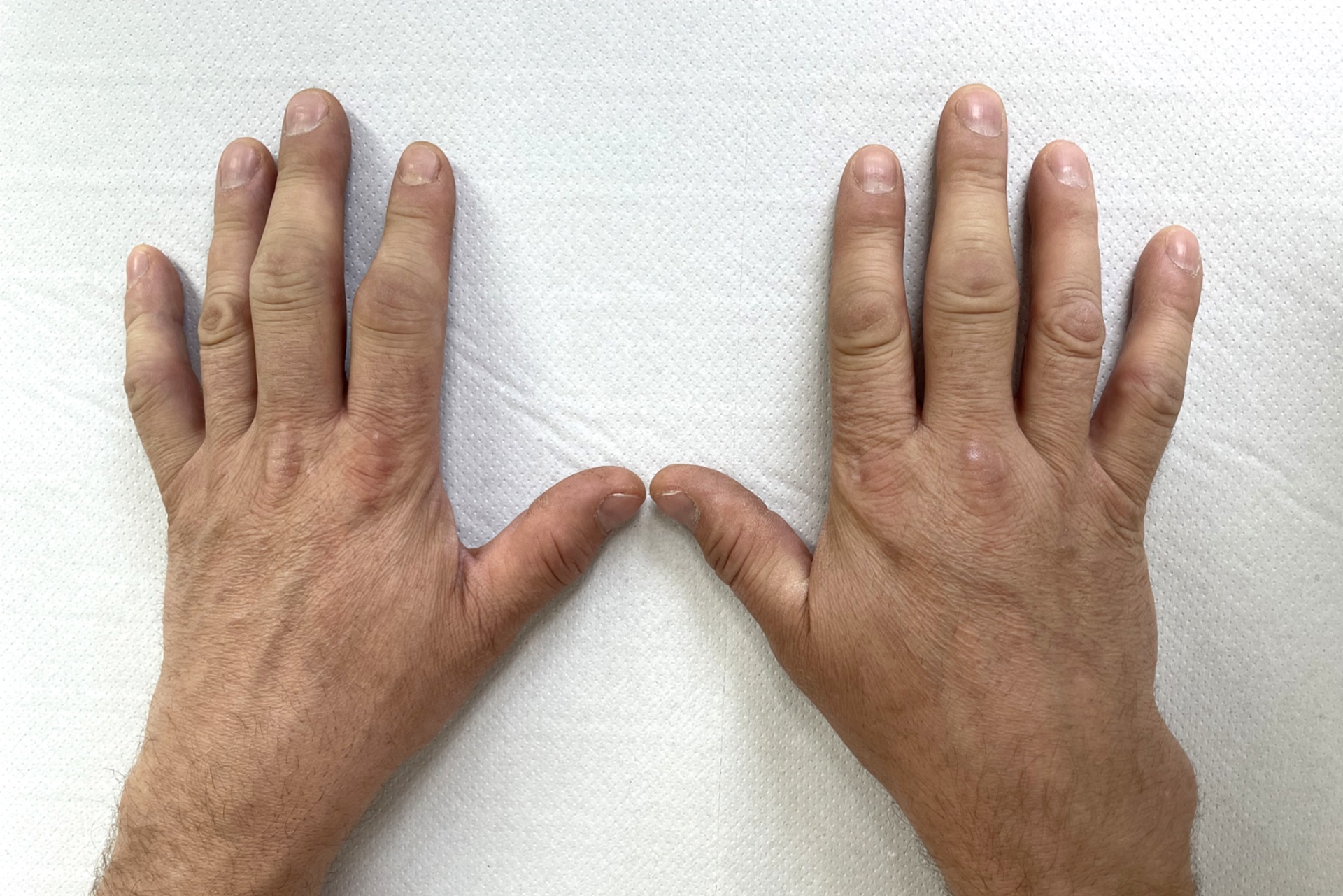 Diet and Nutrition of patients having Rheumatoid hand surgery in Aberdeen, uk by Dr Jamil Ahmed